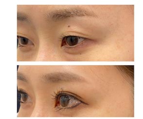 ヴィンテージビューティークリニックの切らない眼瞼下垂の症例