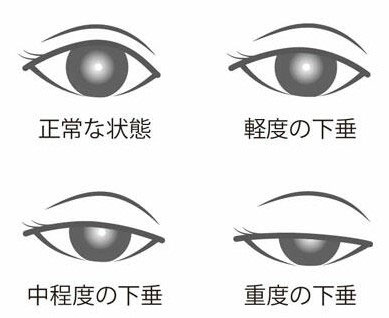 眼瞼下垂の重症度
