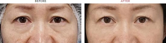 もとび美容外科クリニックにおける目の下のたるみ除去（ハムラ法）の治療例