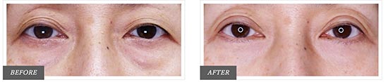 TCB東京中央美容外科の切開法による目の下のたるみ取り（下眼瞼除皺術）の症例