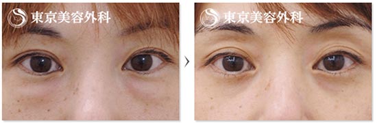 東京美容外科の目の下のたるみ取り（ハムラ法）の症例