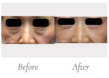 聖心美容クリニックのプレミアムPRP皮膚再生療法（目元のくぼみ・たるみ）の症例
