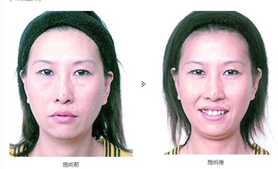 共立美容外科の目の下の脂肪除去の症例