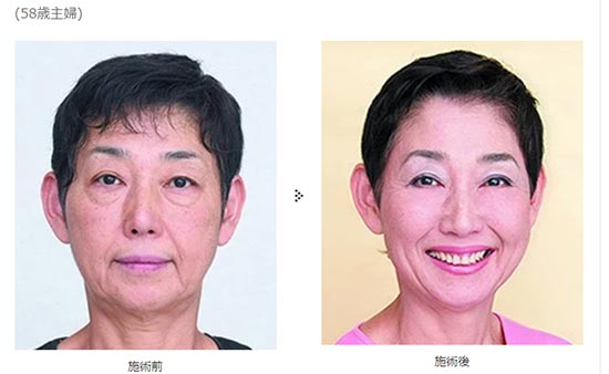 共立美容外科の目の下の脂肪除去の症例