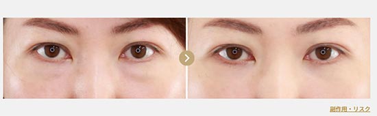 TAクリニックの下眼瞼脱脂術と目の下の脂肪注入の症例