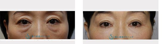 聖心美容クリニックのプレミアムPRP皮膚再生療法（目の下のくま）の症例