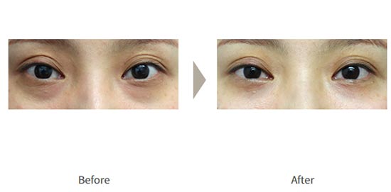 ガーデンクリニックの下瞼脱脂法 の症例