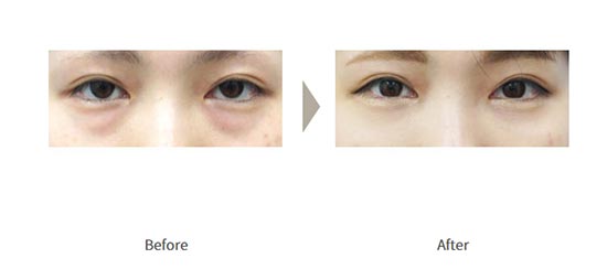 ガーデンクリニックの下瞼脱脂法 の症例