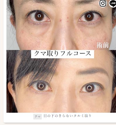 カンナム美容外科の目の下の切らないタルミ取りの症例