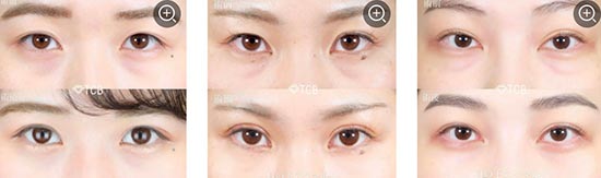 TCB東京中央美容外科の切らない目の下のクマ取り・目の下のたるみ取りの症例