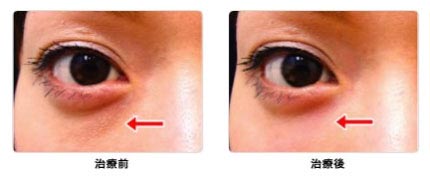 シロノクリニックの目の下 注入治療（ヒアルロン酸注入）の症例