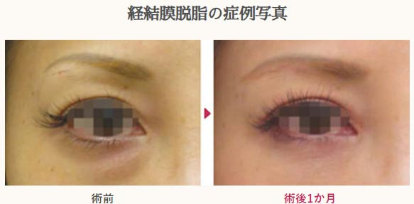 真崎医院の経結膜的眼窩脂肪切除術の症例