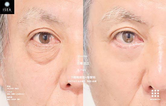 東京イセアクリニックの下眼瞼脱脂+除皺術の症例