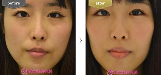 東京美容外科のエラボツリヌストキシン|gzの症例