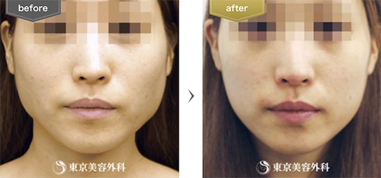 東京美容外科のエラボツリヌストキシンの症例