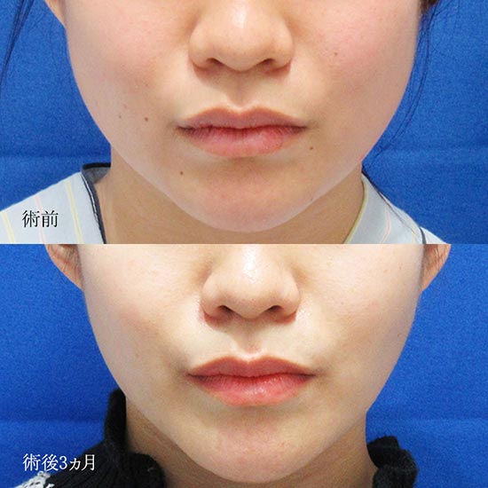 水の森美容クリニックの顔の脂肪吸引（頬＋顎下）＋エラのボトックス注射の症例
