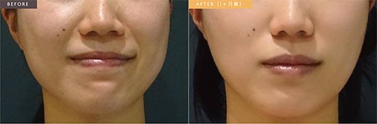 ルシアクリニックの小顔ボトックス（エラ）の症例