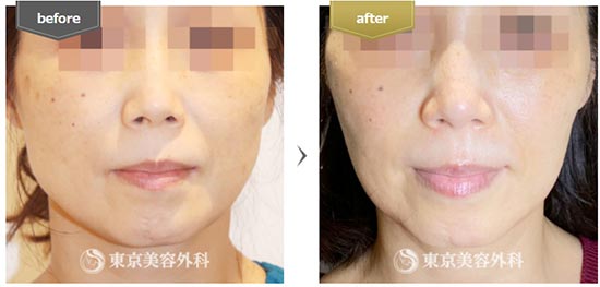 東京美容外科のエラボトックスの症例