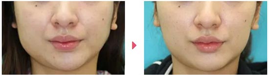 大塚美容外科のエラボトックスの症例