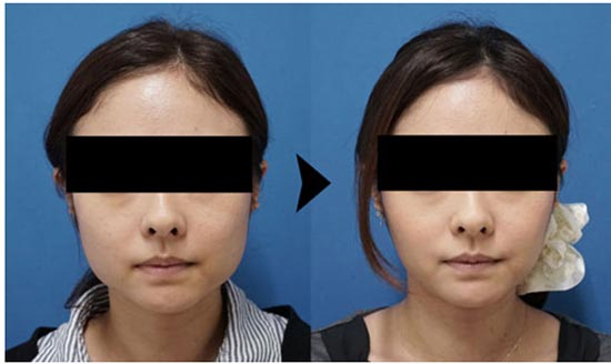 もとび美容外科クリニックのアラガン強力小顔ボトックスの症例