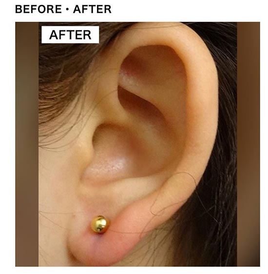 TCB東京中央美容外科のピアス穴開け（耳）の症例