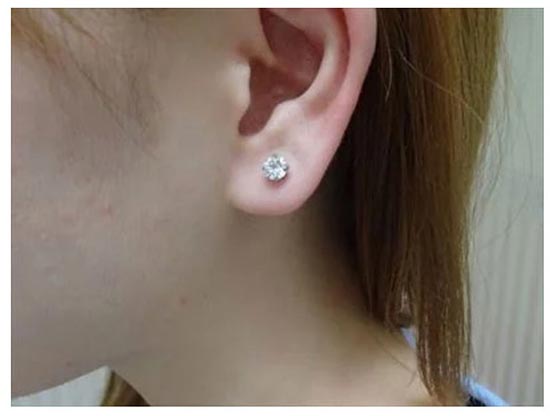 共立美容外科のピアス（片耳）の症例