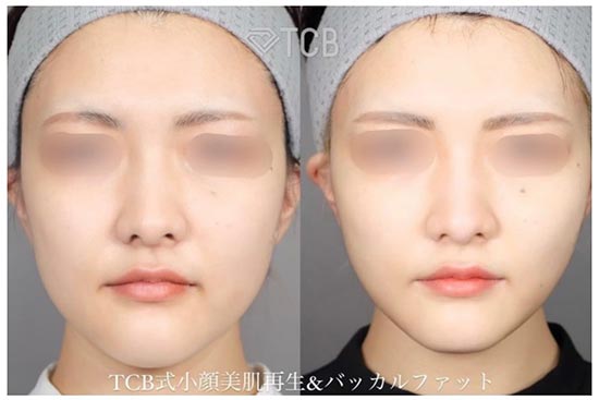 TCB東京中央美容外科の糸リフトの症例