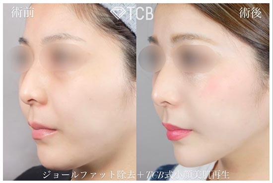 TCB東京中央美容外科の糸リフトの症例