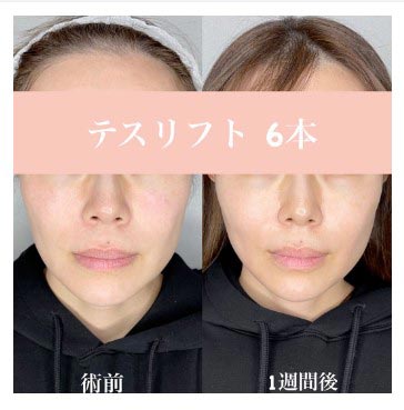 カンナム美容外科のテスリフト6本の症例