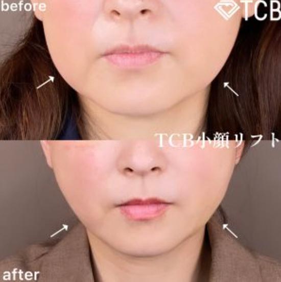 TCB東京中央美容外科のTCB小顔リフトの症例