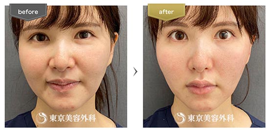 東京美容外科のGコグプレスの症例