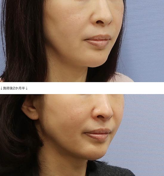 CLASSY 仙台美容外科・美容皮膚科の小顔Vフェイス+チークリフトの症例