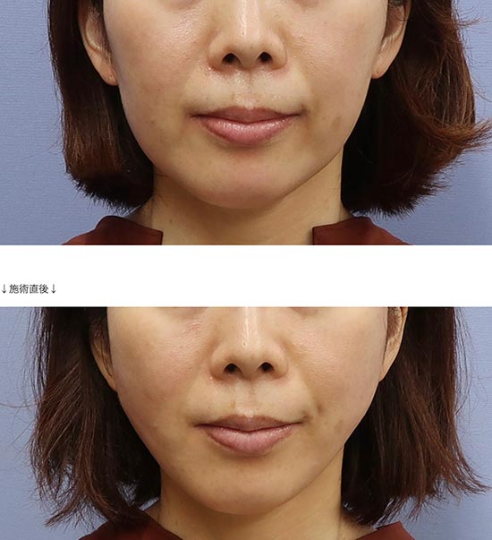 CLASSY 仙台美容外科・美容皮膚科の小顔Vフェイスの症例