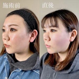 TCB東京中央美容外科のTCB小顔リフト＋エラボトックス小顔注射＋あごのヒアルロン酸注射＋ほうれい線のヒアルロン酸注射の症例