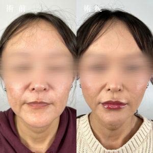 TCB東京中央美容外科の小顔リフトの症例