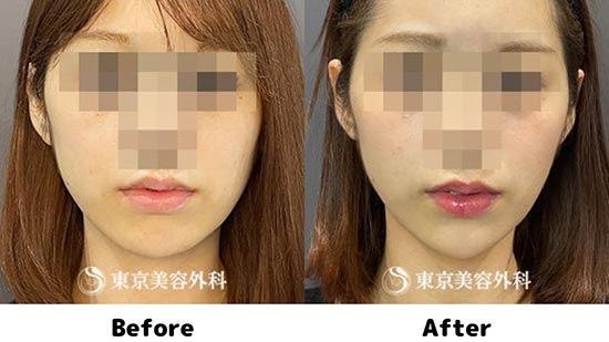 東京美容外科のテスリフト4本＋顎ヒアルロン酸注入の症例