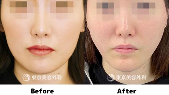 東京美容外科のオルチャンリフトの症例