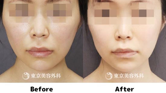東京美容外科のミントリフトⅡ Winkの症例