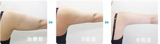 名古屋中央クリニックの脂肪溶解注射 二の腕　脂肪溶解注射の症例