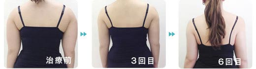 名古屋中央クリニックの脂肪溶解注射 二の腕の症例