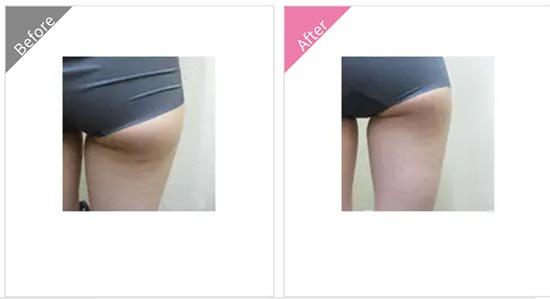 渋谷美容外科クリニックの脂肪溶解注射(短期治療タイプ)の症例