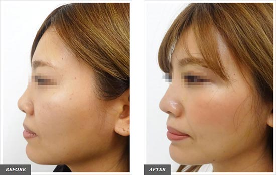 TCB東京中央美容外科の隆鼻術（シリコンプロテーゼ）の症例