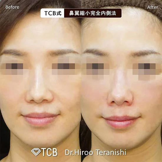 TCB東京中央美容外科のTCB式鼻翼縮小完全内側法の症例