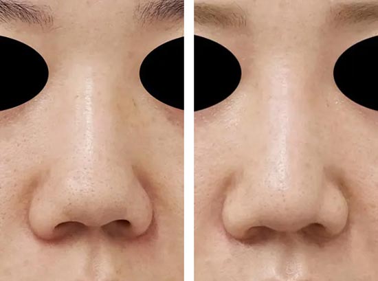 もとび美容外科クリニックの鼻尖縮小、鼻中隔延長、鼻柱基部下降の症例