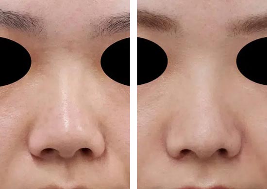 もとび美容外科クリニックの鼻翼縮小（内側＋外側）、鼻尖縮小、軟骨移植の症例