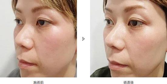 共立美容外科の隆鼻術の症例