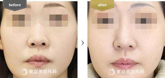東京美容外科の鼻オーダーメイドプロテーゼの症例