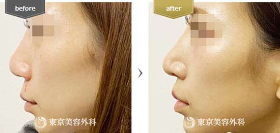 東京美容外科の小鼻縮小内側切開、鼻尖形成（軟骨移植）の症例
