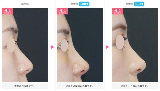湘南美容クリニックの鼻尖形成3D法の症例