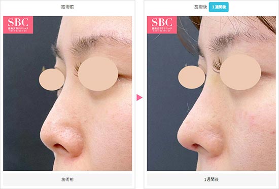 湘南美容クリニックの鼻中隔延長+鼻尖形成3D法+鼻尖部軟骨移植の症例